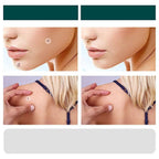 SkinClear - Patch for the removal of spots and warts Kalsten 5